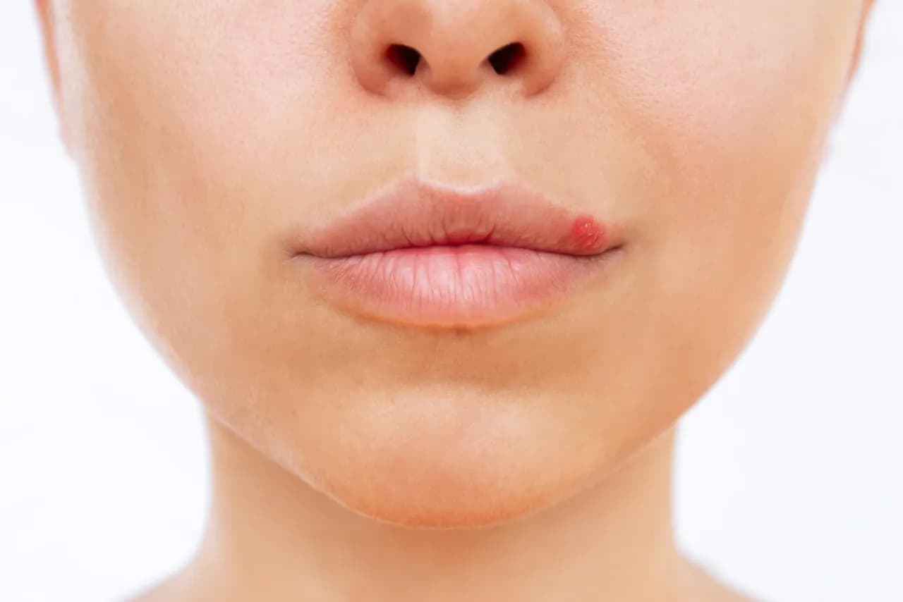 Jak zapobiec opryszczce: skuteczne metody na unikanie nawrotów